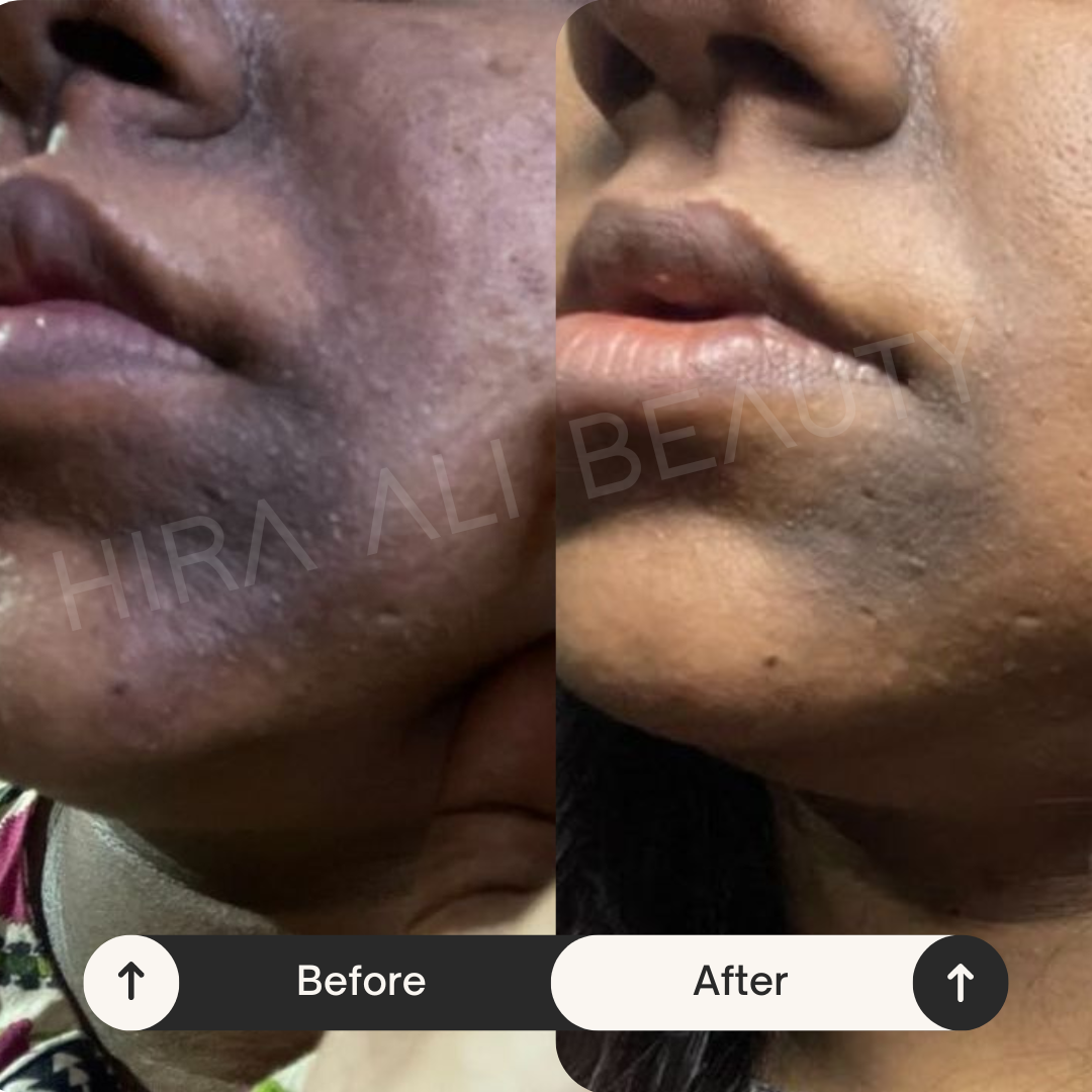 Bright Monster Serum - Alpha Arbutin 2% + HA - Hira Ali 