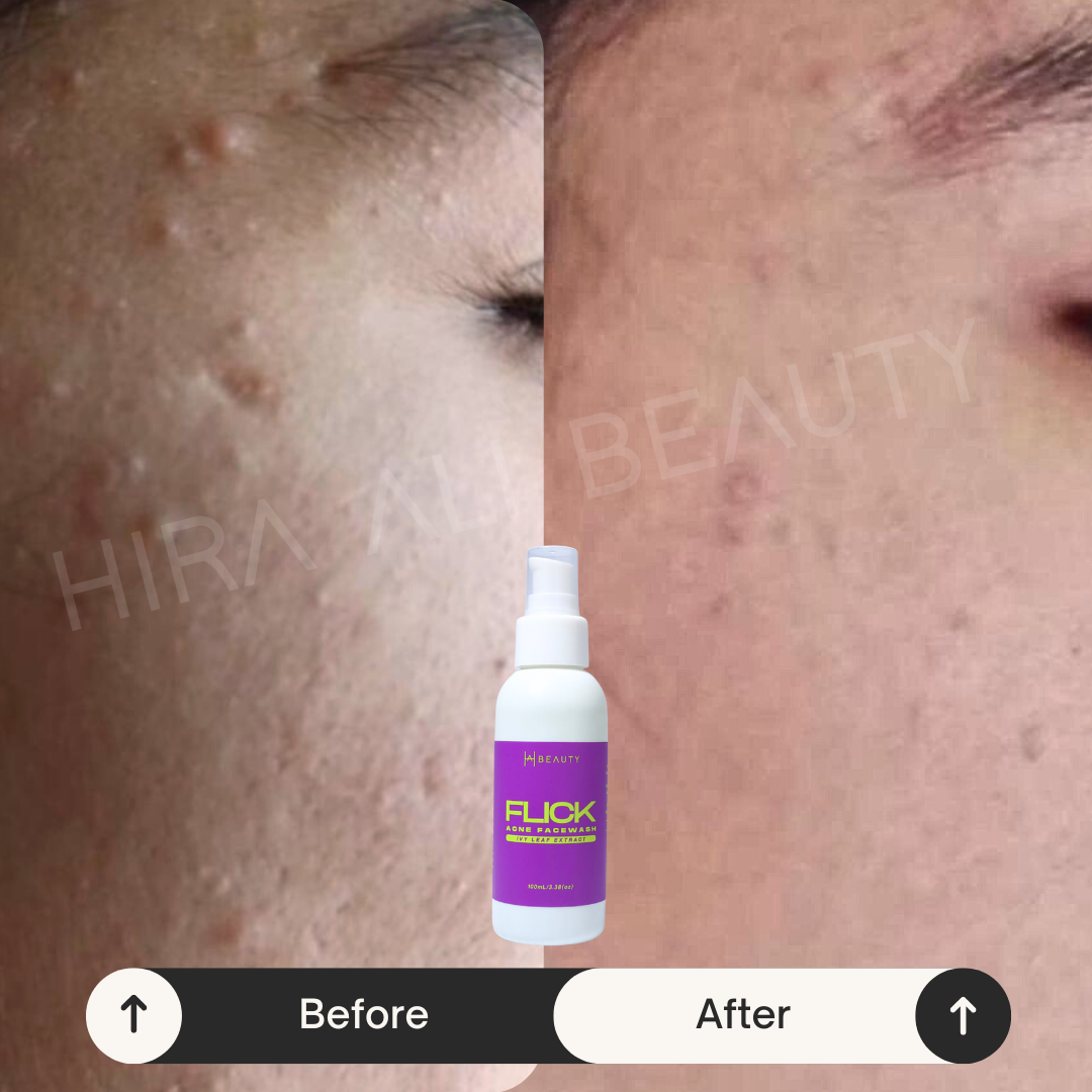 Acne Killin' Duo - Hira Ali 