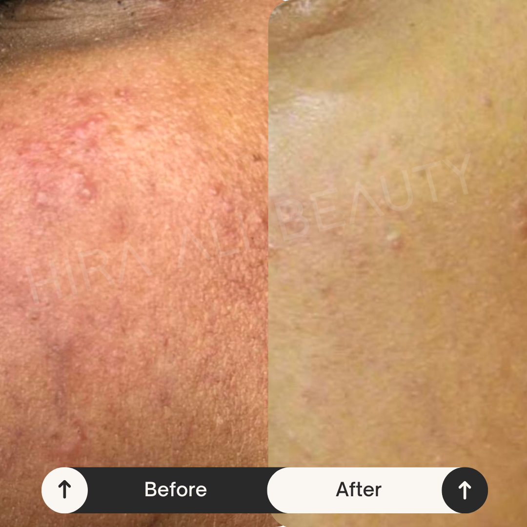 Salicylic Acid + Ivy Leaf - Flick Acne Serum - Hira Ali 