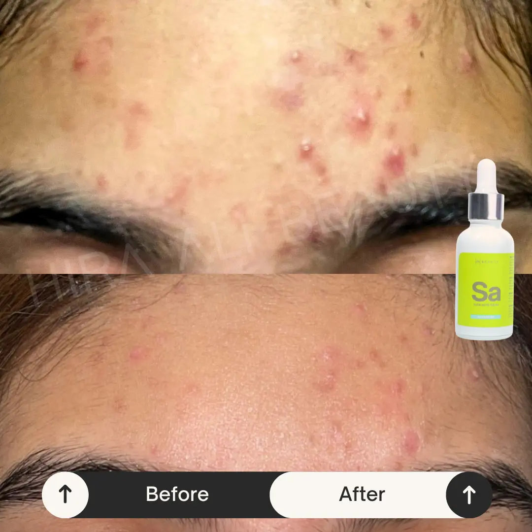 Acne Killin' Duo - Hira Ali 