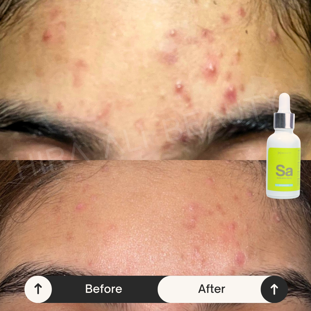 Salicylic Acid + Ivy Leaf - Flick Acne Serum