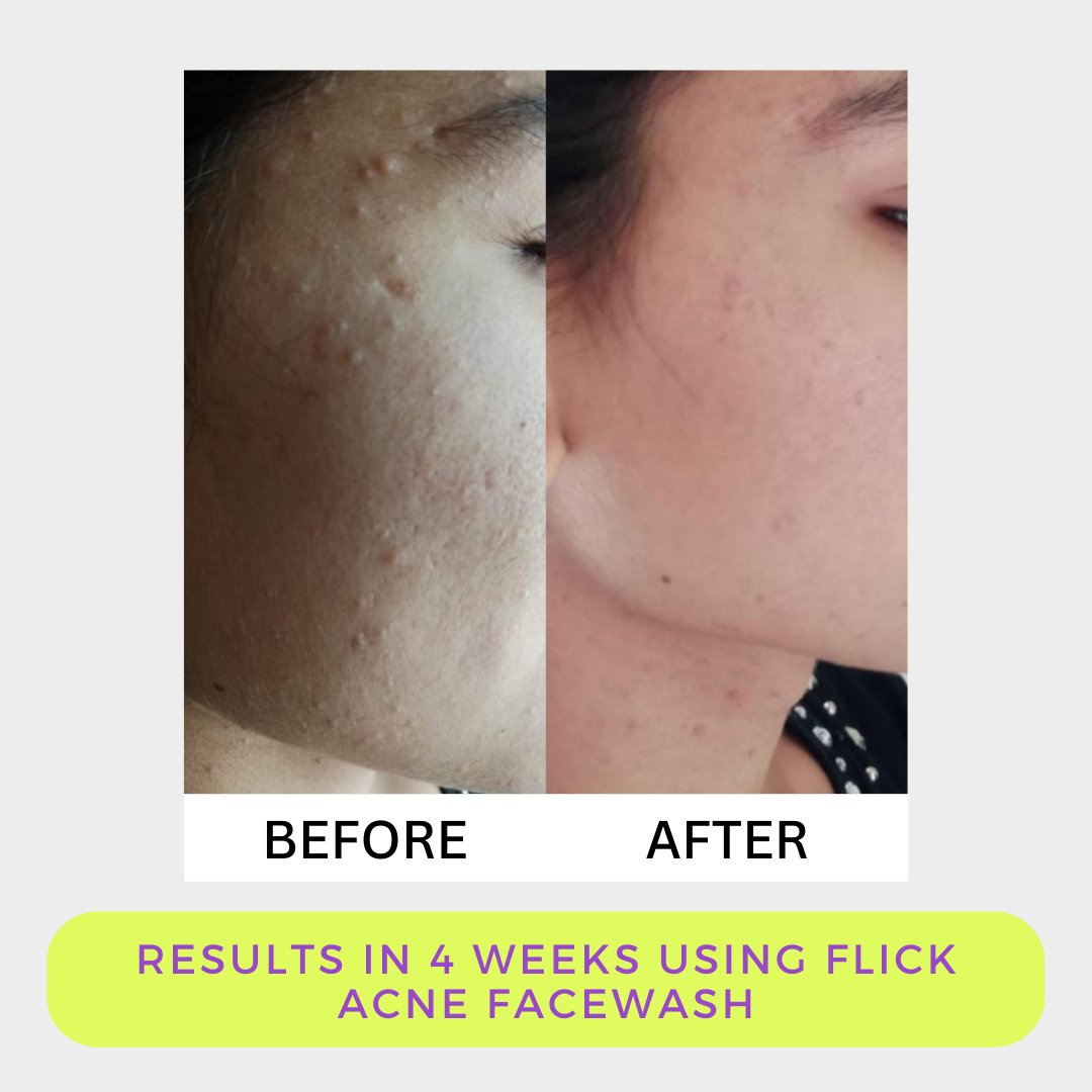 Flick Acne Facewash - Hira Ali