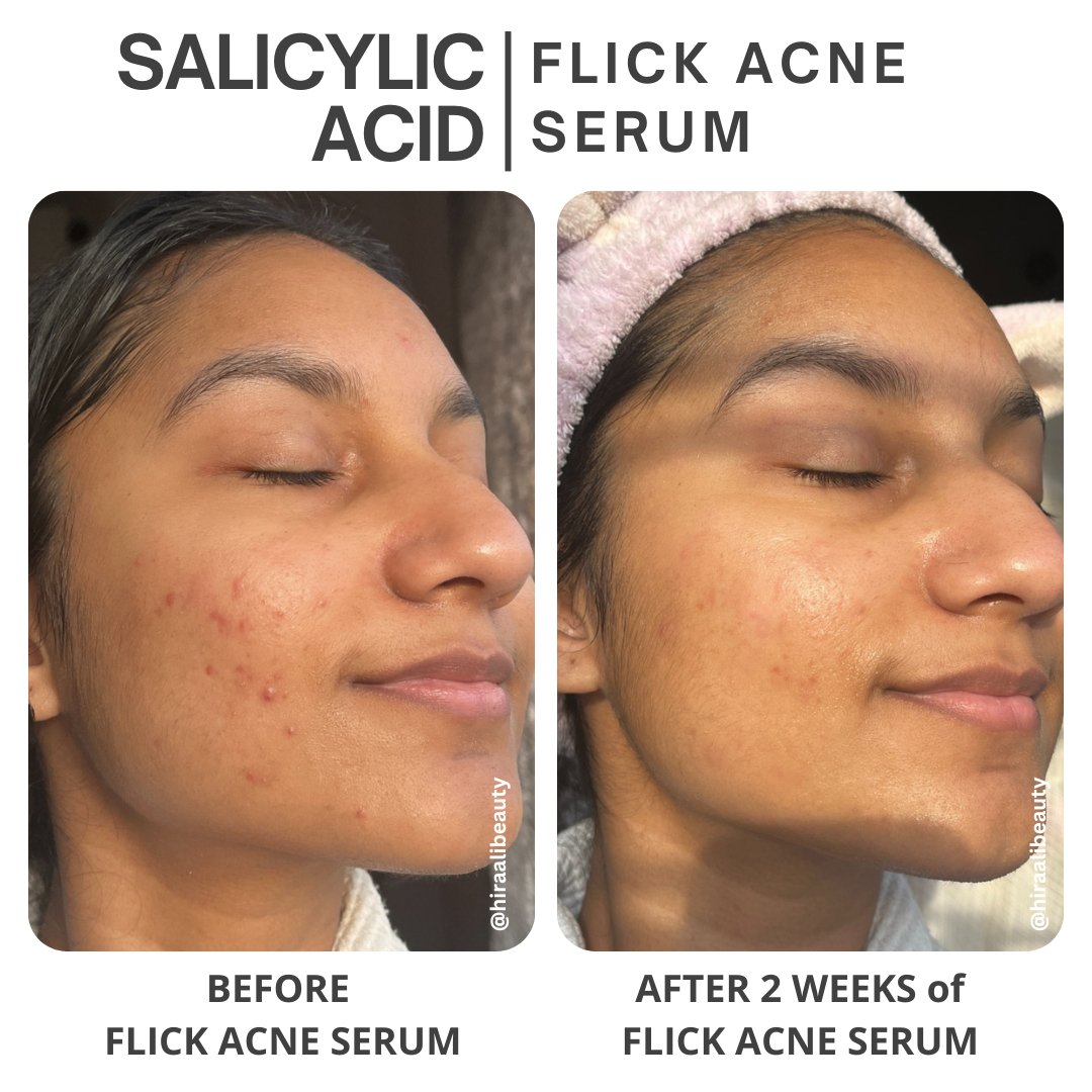 Salicylic Acid + Ivy Leaf - Flick Acne Serum - Hira Ali