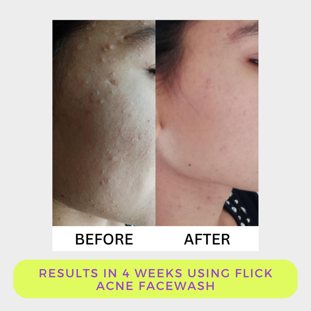 Flick Acne Facewash